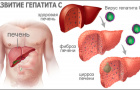 Профилактика ГЕПАТИТА С